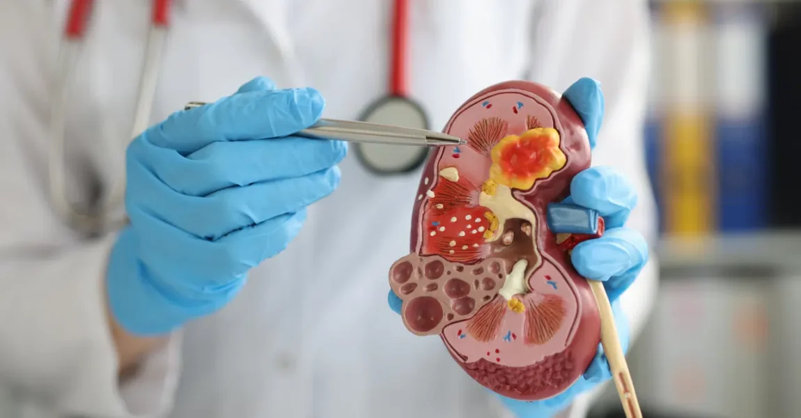 Cara mencegah batu ginjal